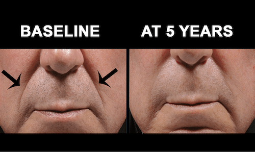 bellafill long lasting wrinkle reduction before after